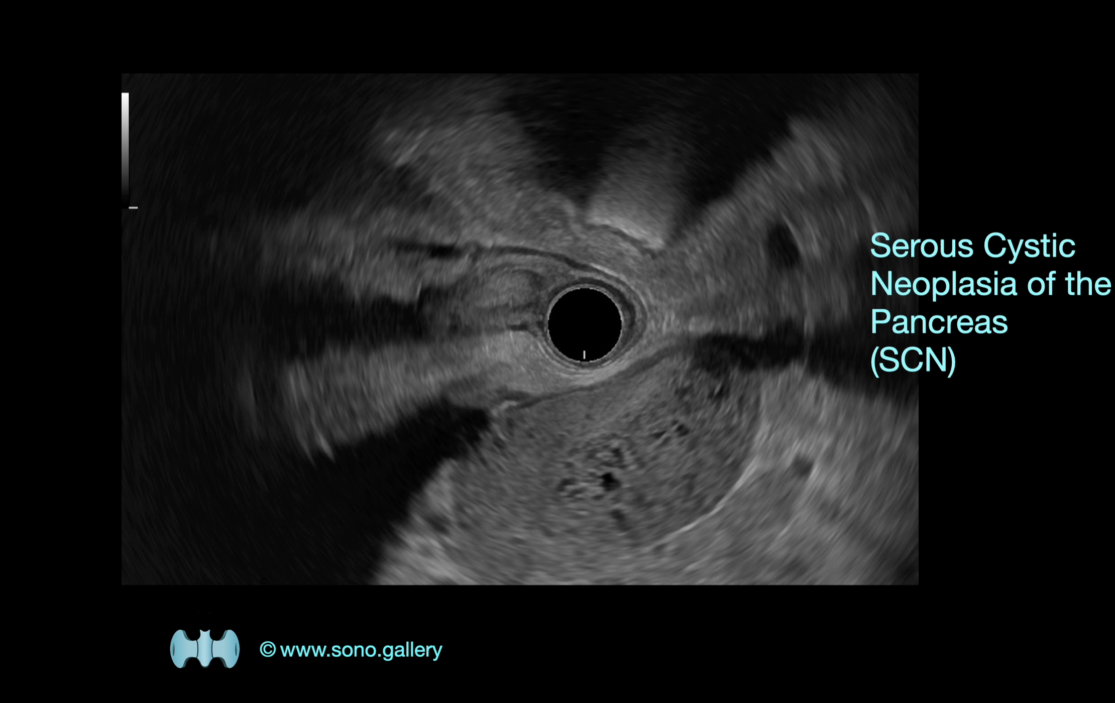 Serous Cystic Neoplasia of the Pancreas (SCN)