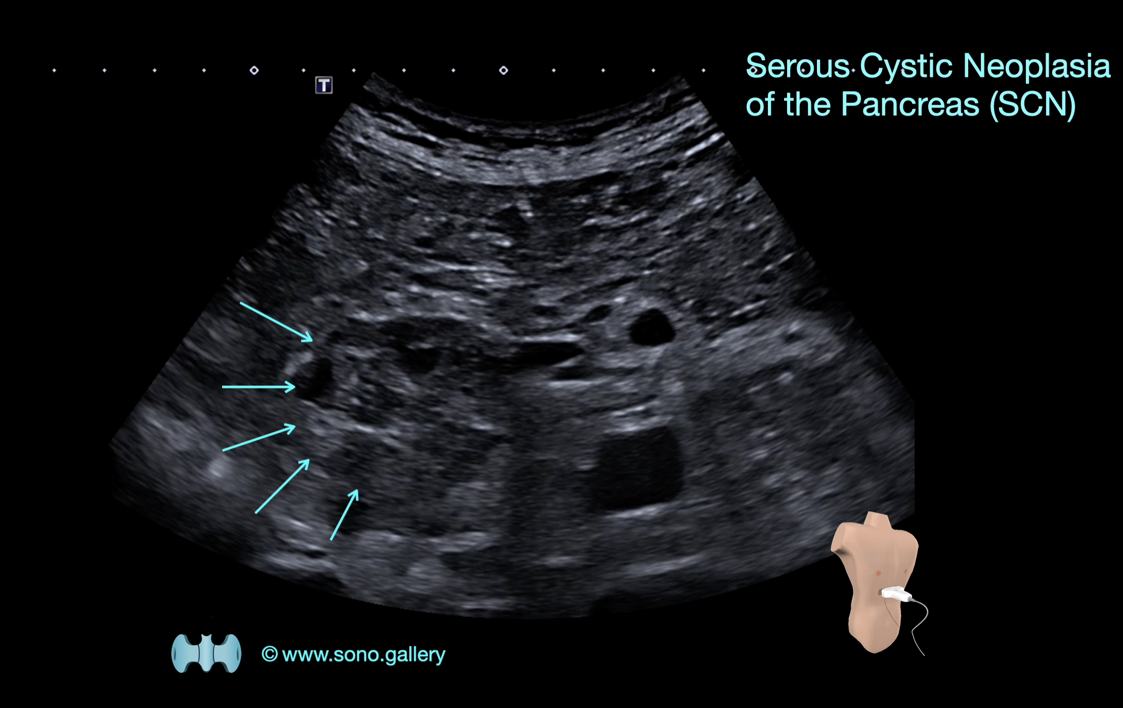 Serous Cystic Neoplasia of the Pancreas (SCN)