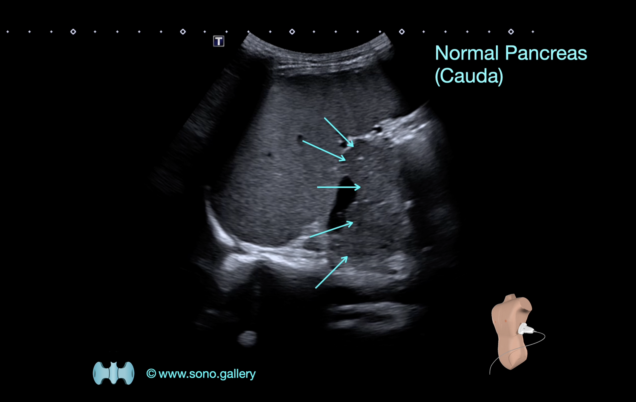 Pancreas (Cauda)