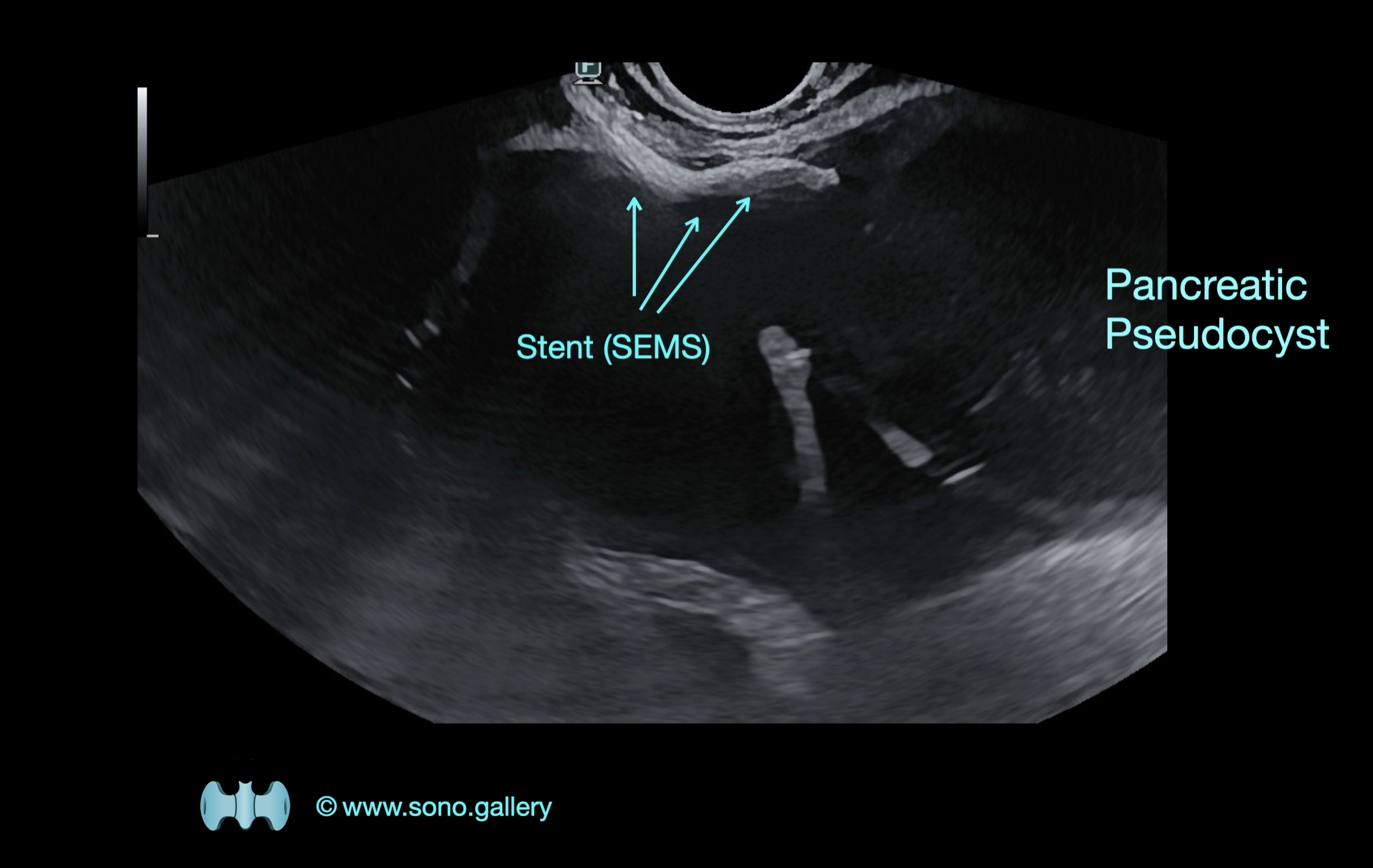 Pancreatic Pseudocyst
