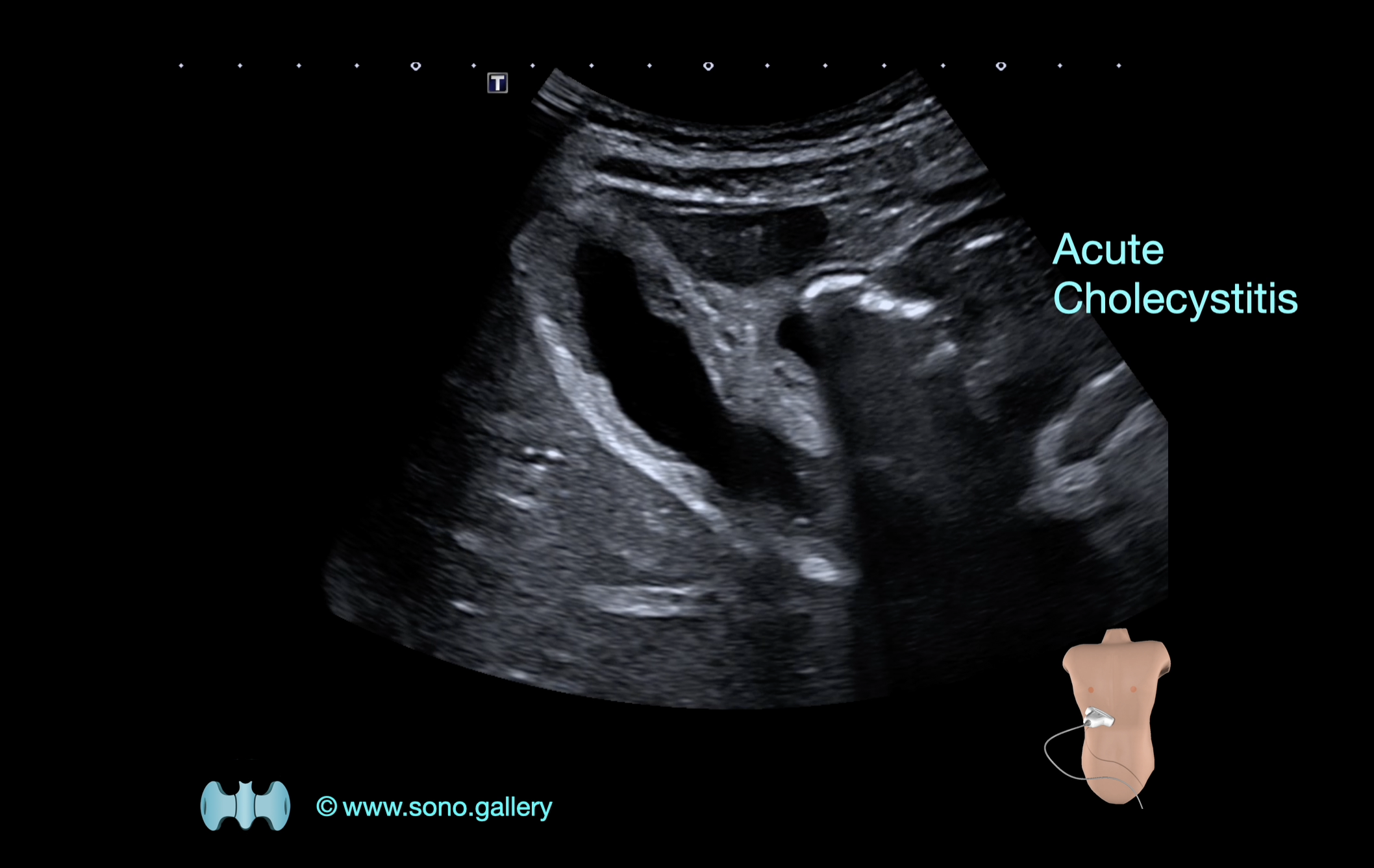 Acute Cholecystitis