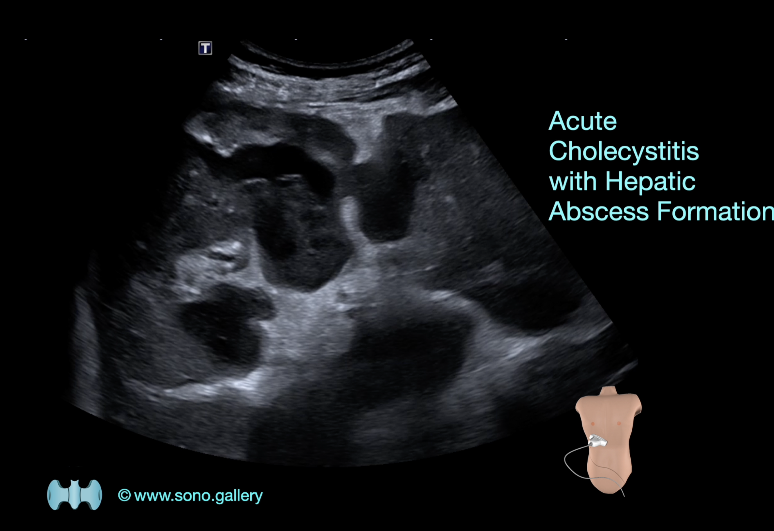 Acute Cholecystitis with Hepatic Abscess Formation