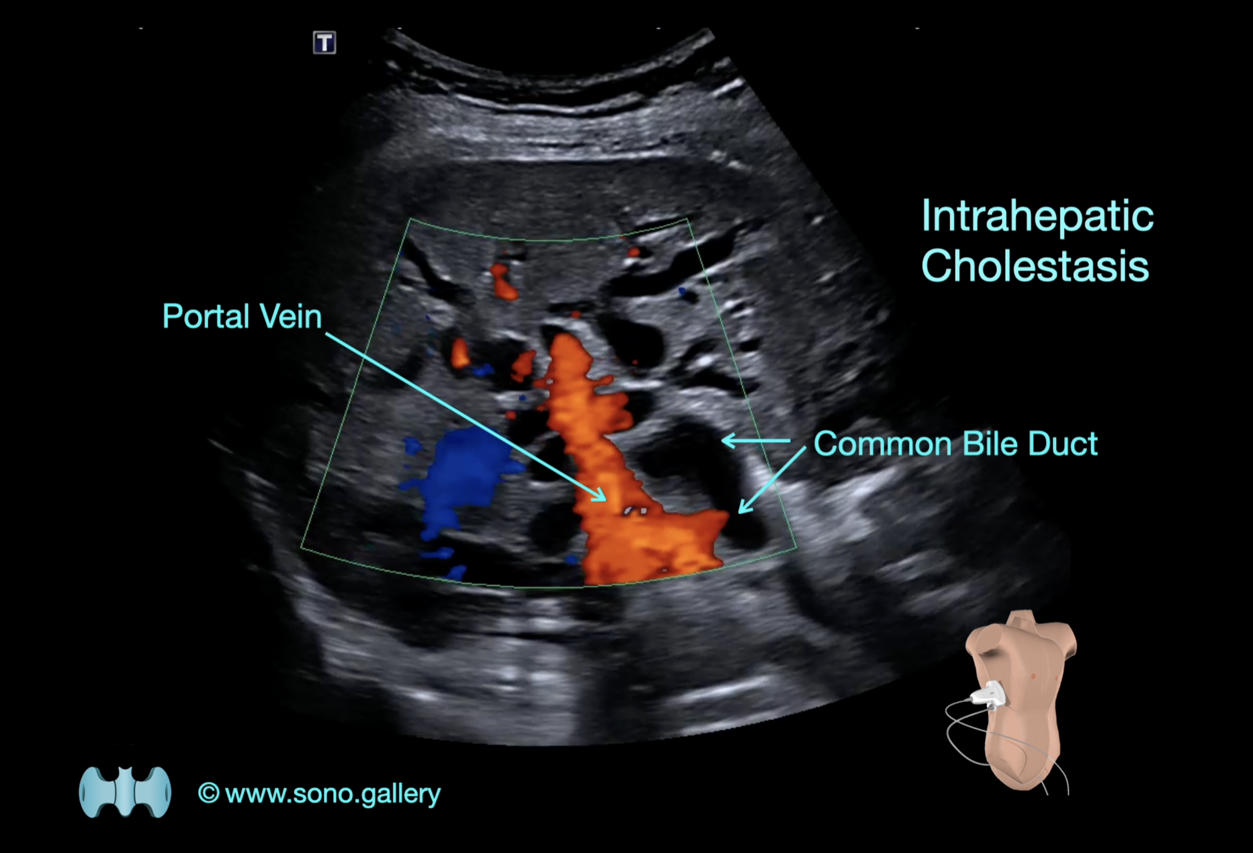 Intrahepatic Cholestasis
