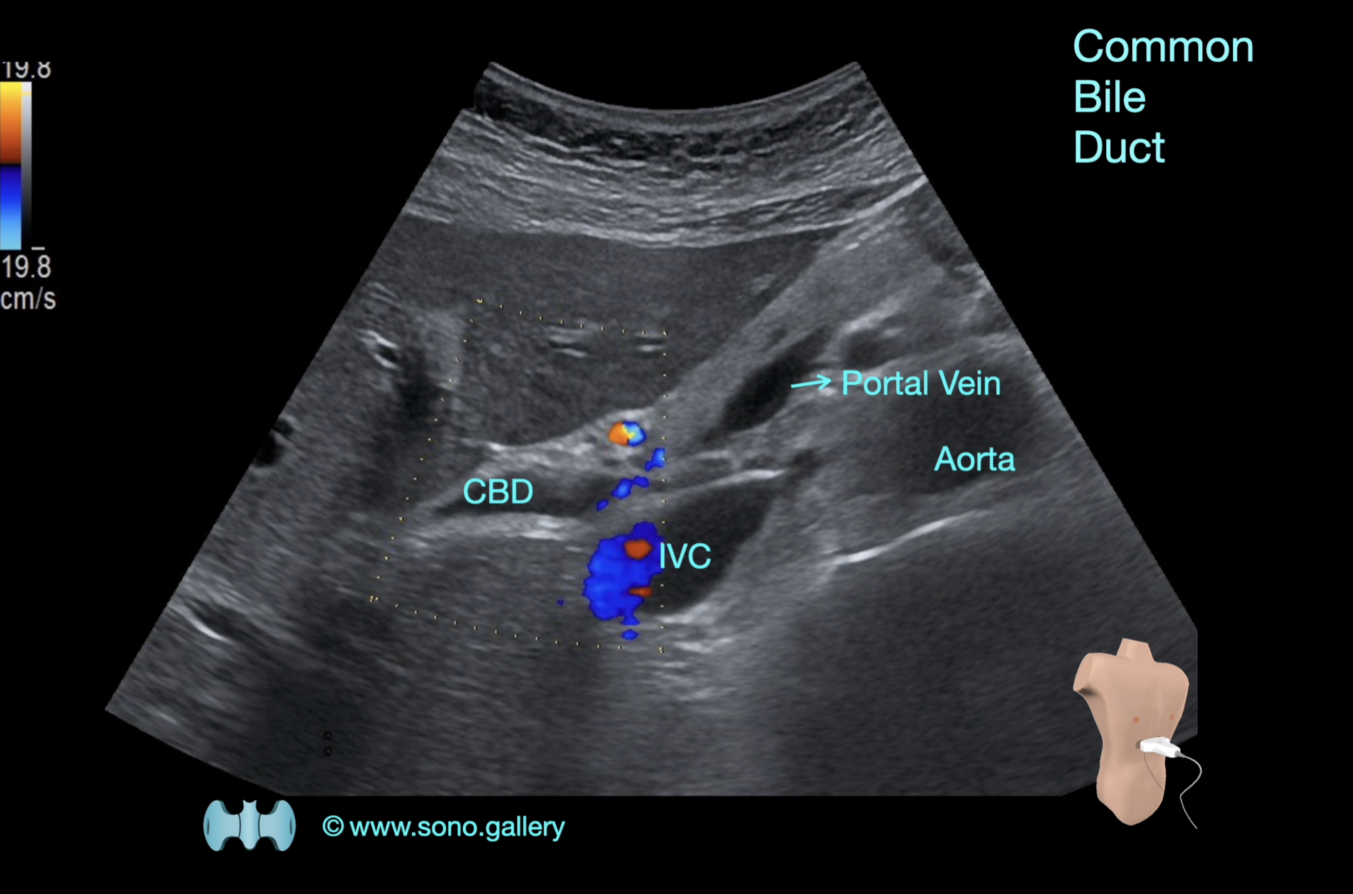 Common Bile Duct