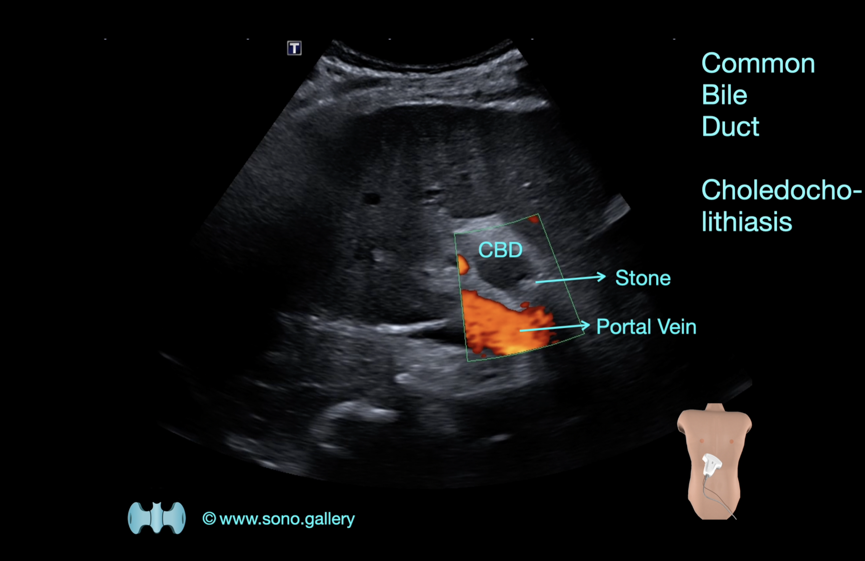 Common Bile Duct, Choledocholithiasis