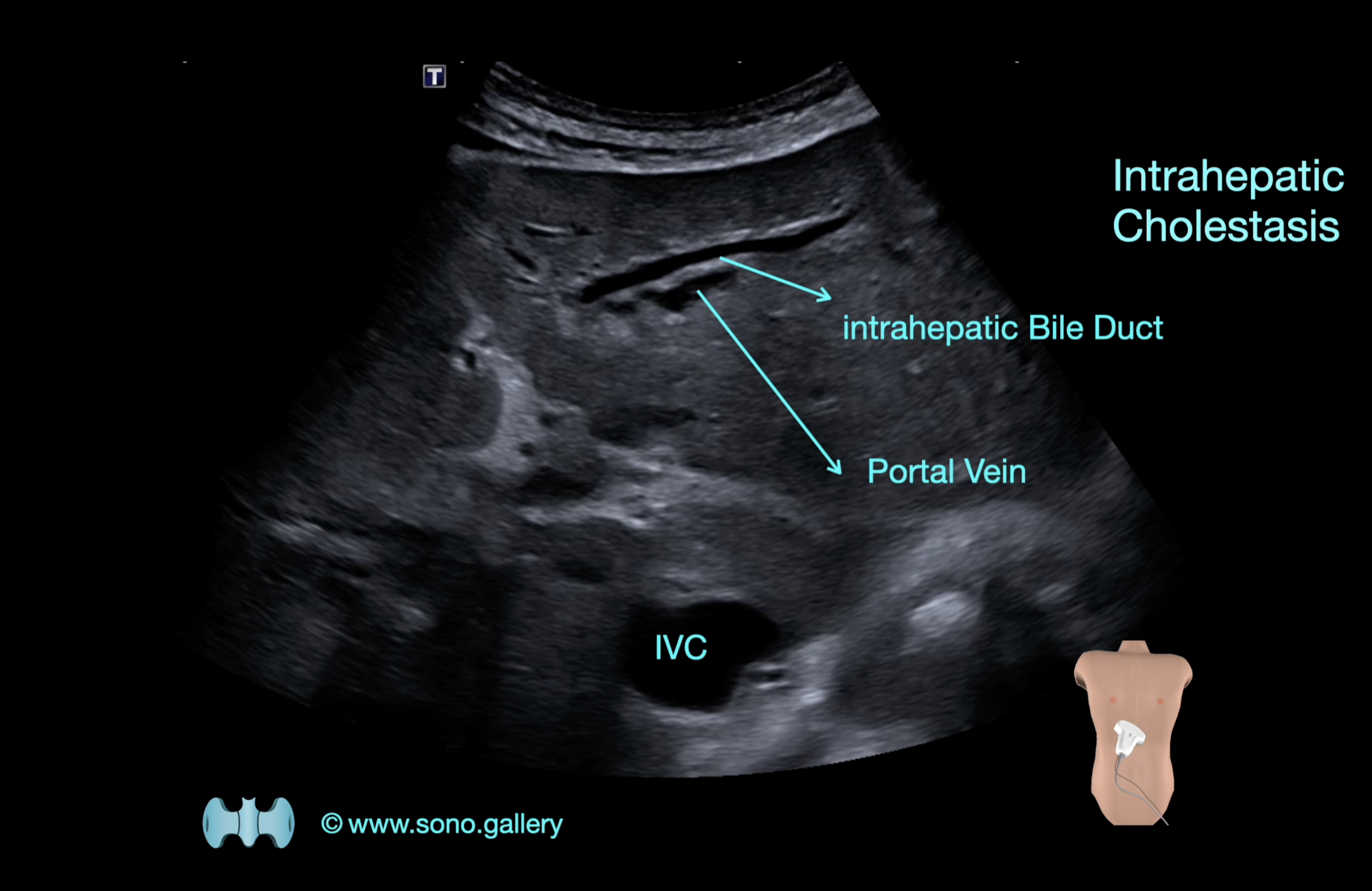 Intrahepatic Cholestasis