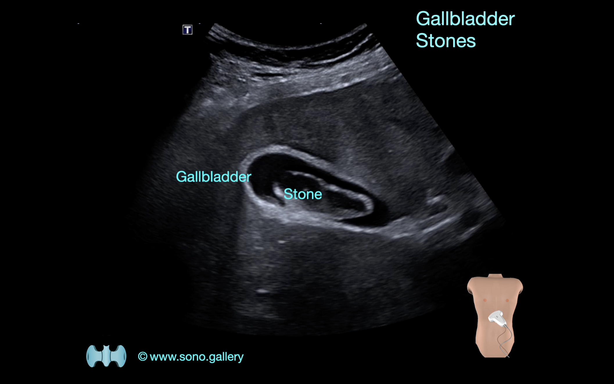 Gallbladder Stones