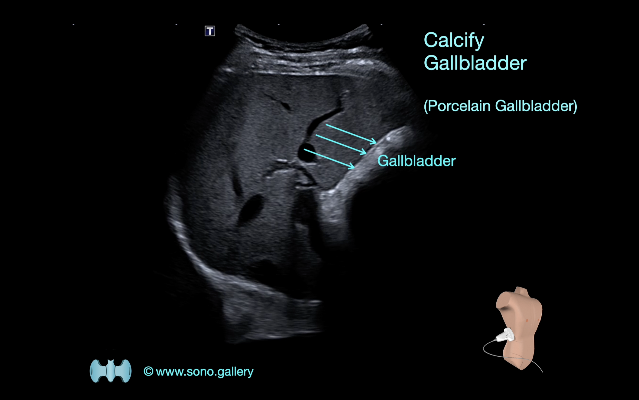 Calcifying Cholecystitis (Porcelain Gallbladder)