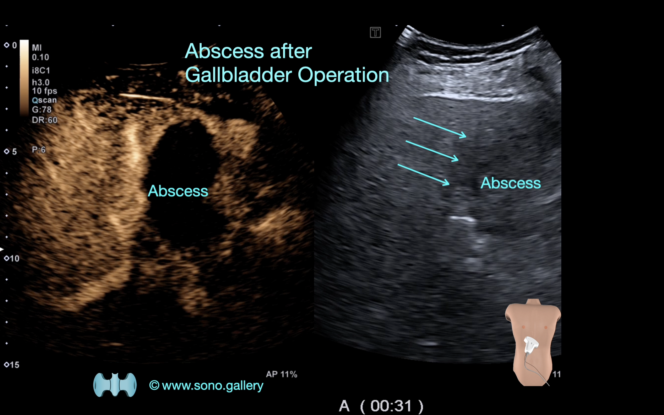 Abscess after Cholecystektomy