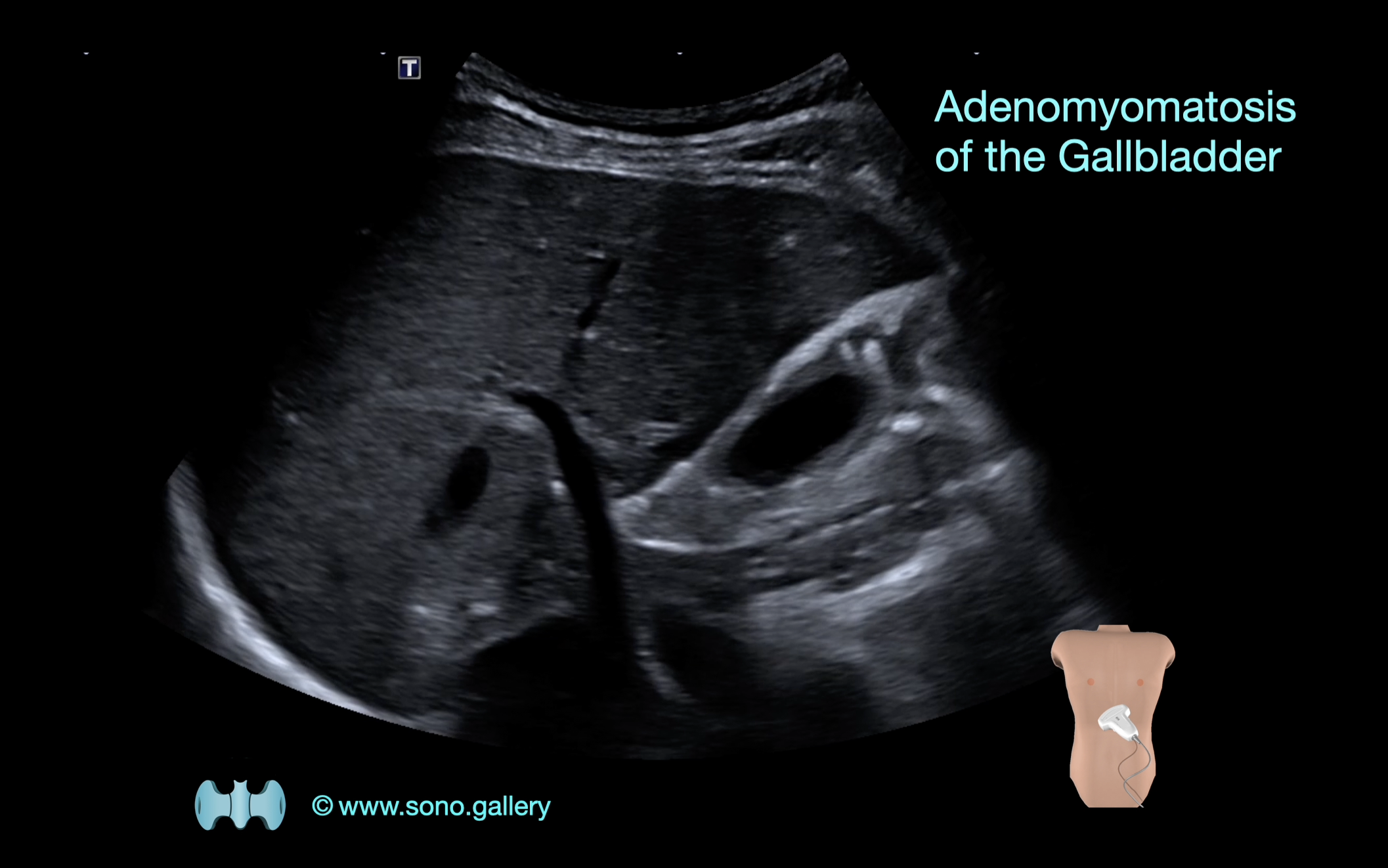 Adenomyomatosis of the Gallbladder
