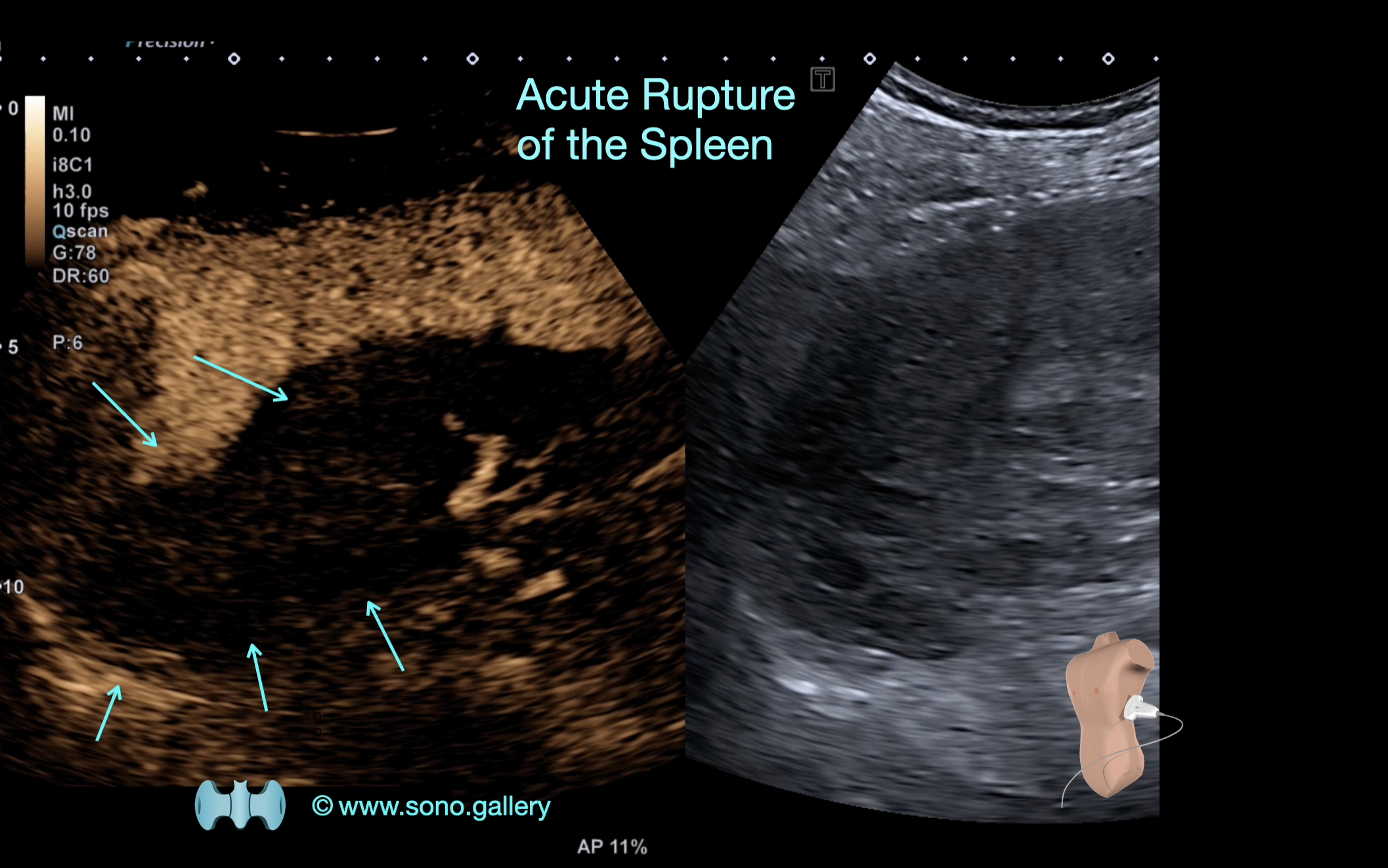 Acute Rupture of the Spleen