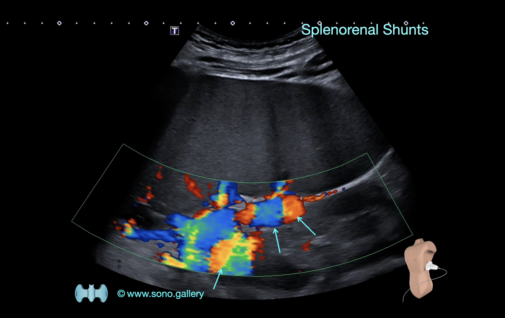 Splenorenal Shunts