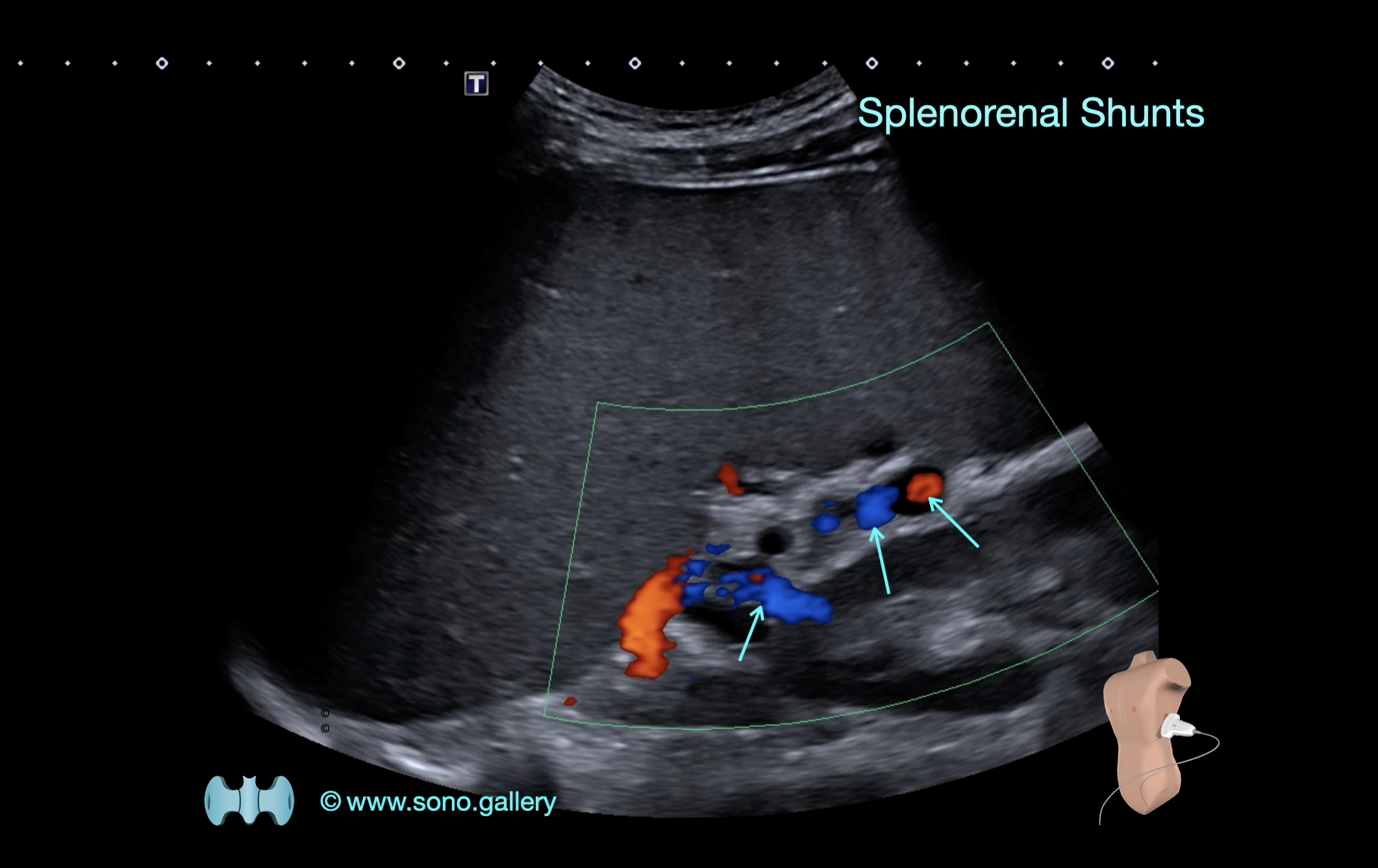 Splenorenal Shunts