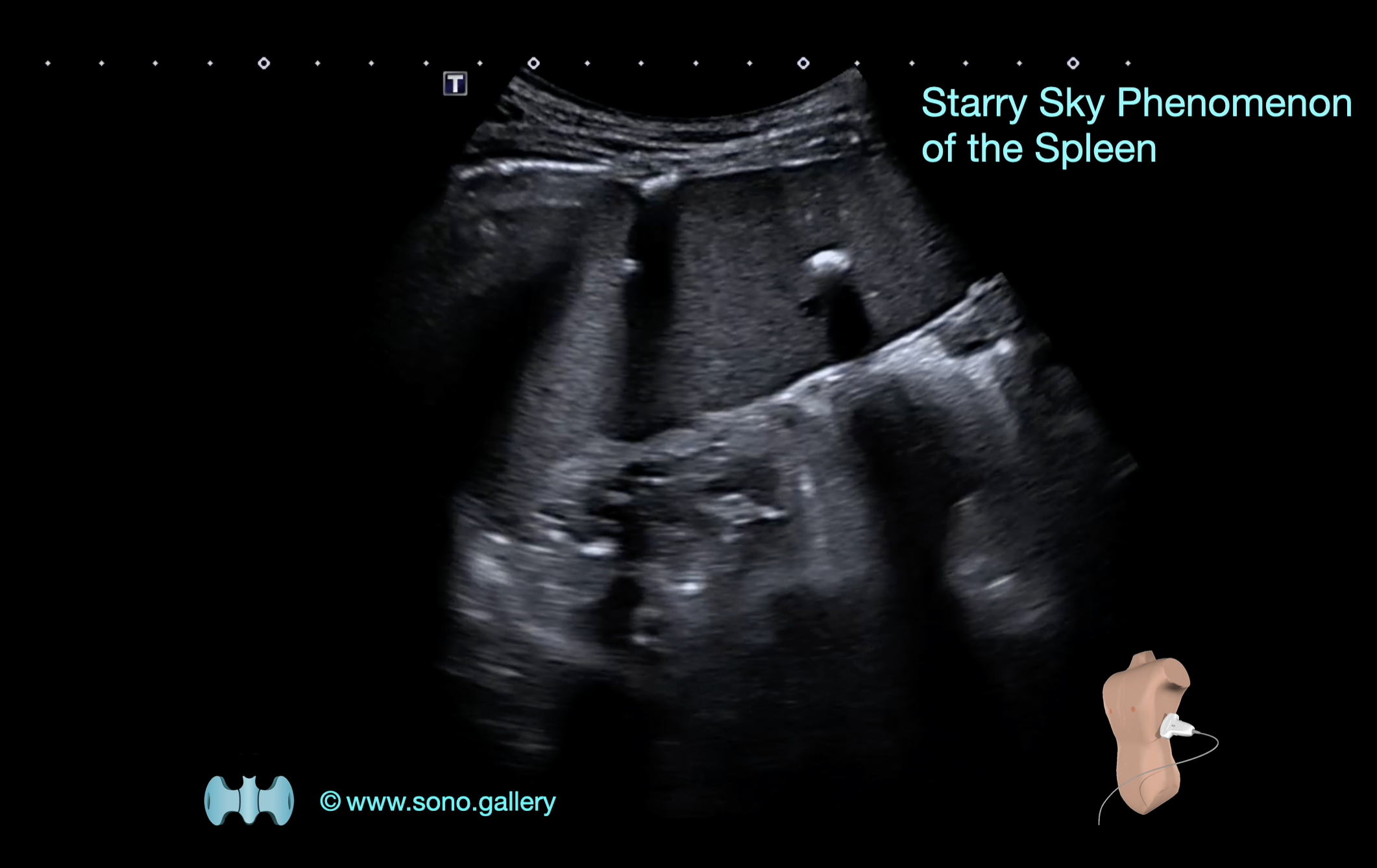 Skarry Sky Phenomenon of the Spleen
