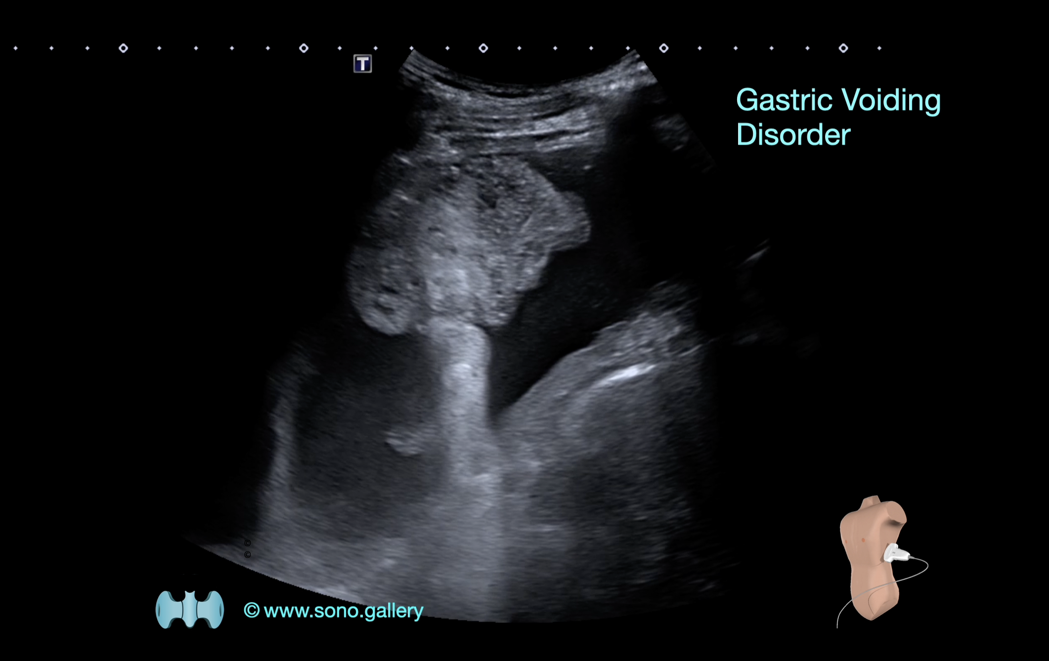 Gastric Voiding Disorder