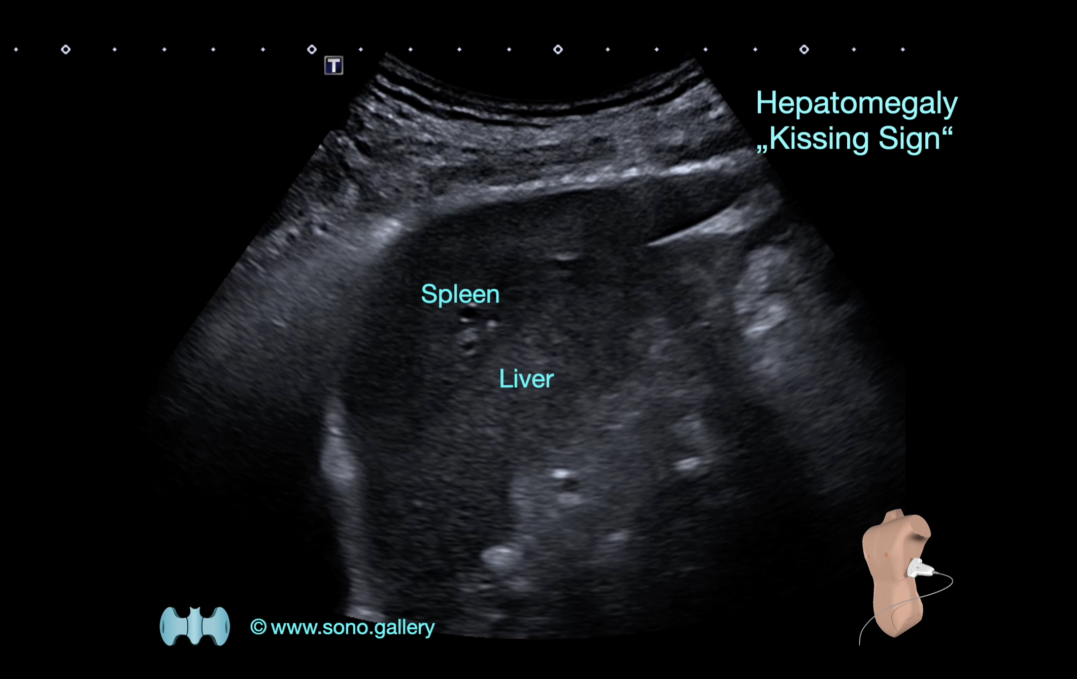 Hepatomegaly ("Kissing-Sign")
