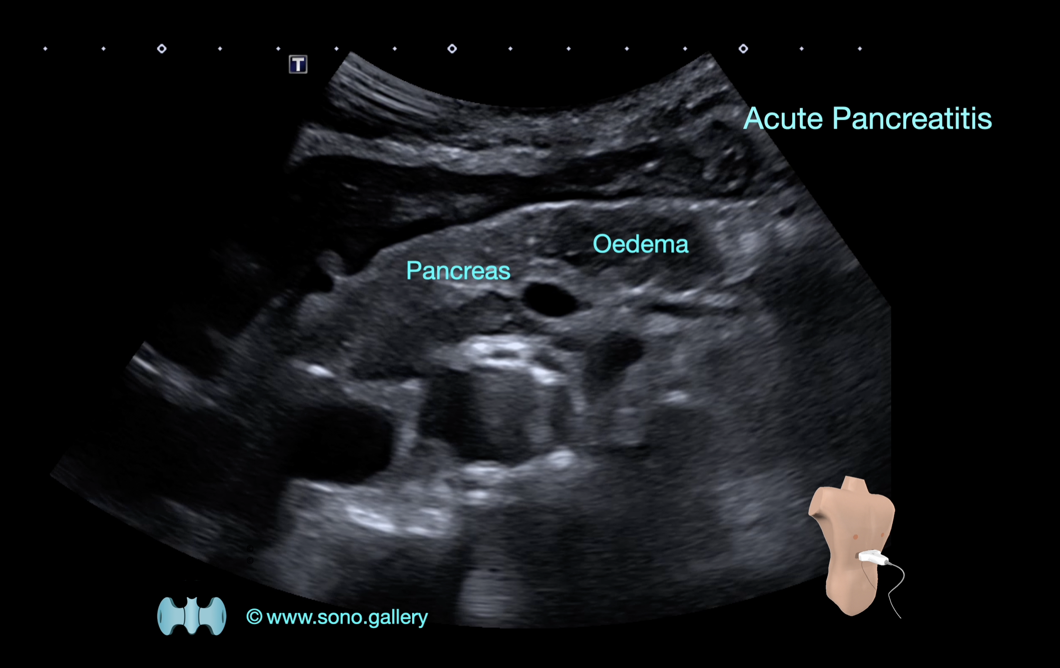 Acute Pancreatitis