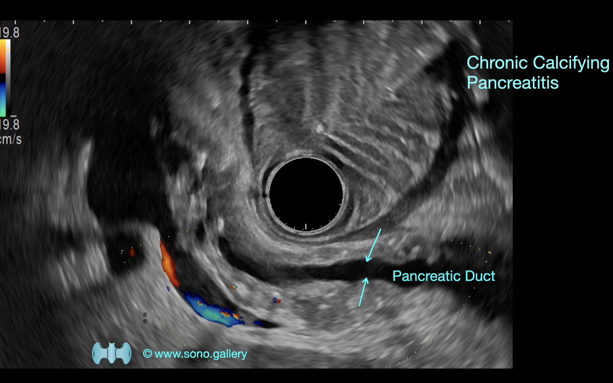 Chronic Calcifying Pancreatitis