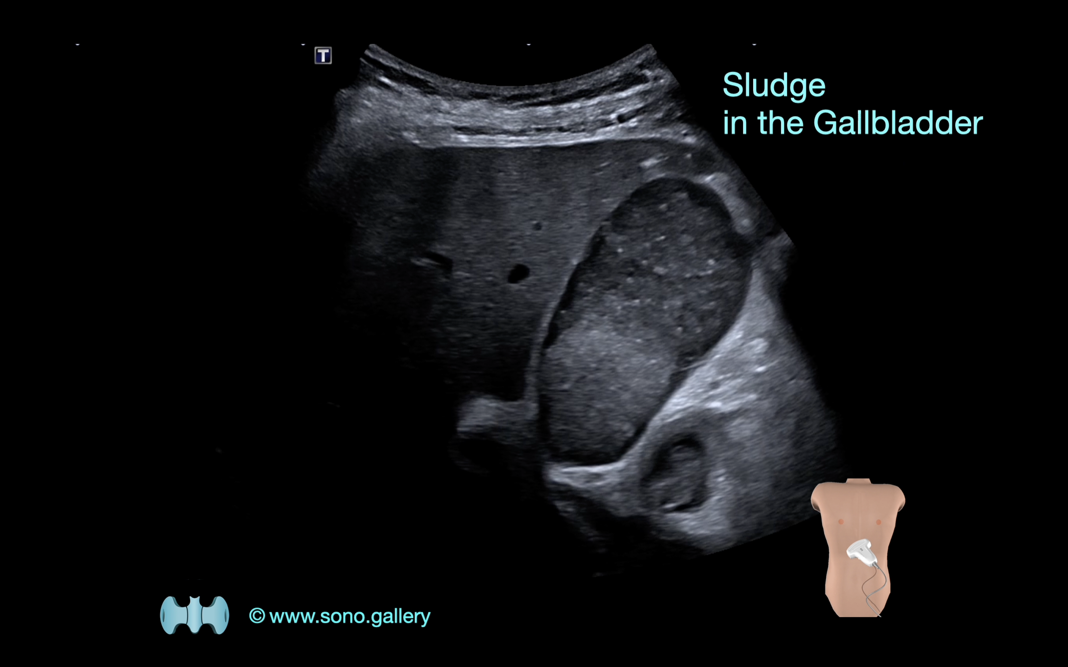 Sludge in the Gallbladder 