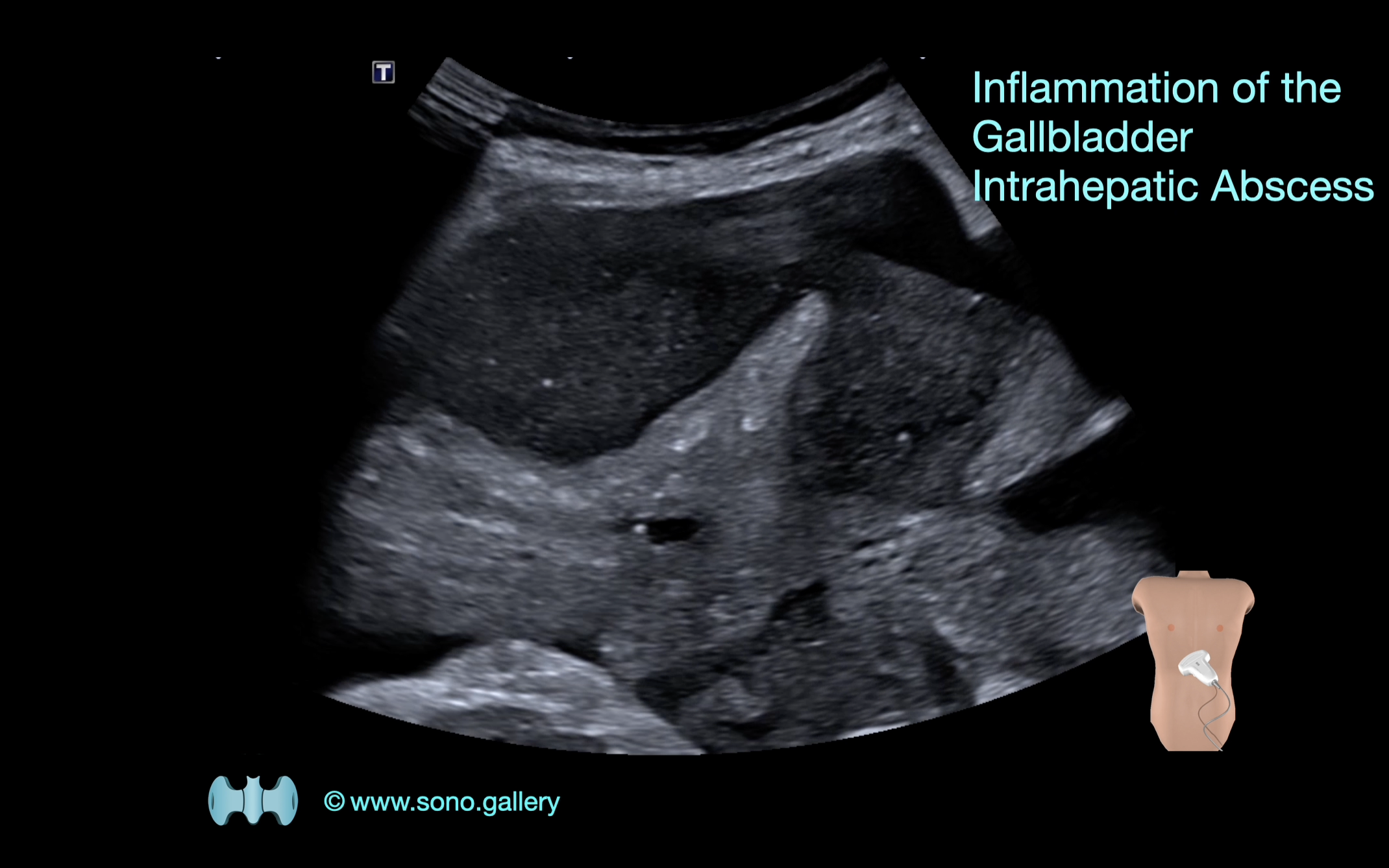 Inflammation of the Gallbladder (Cholecystitis), Intrahepatic Abscess