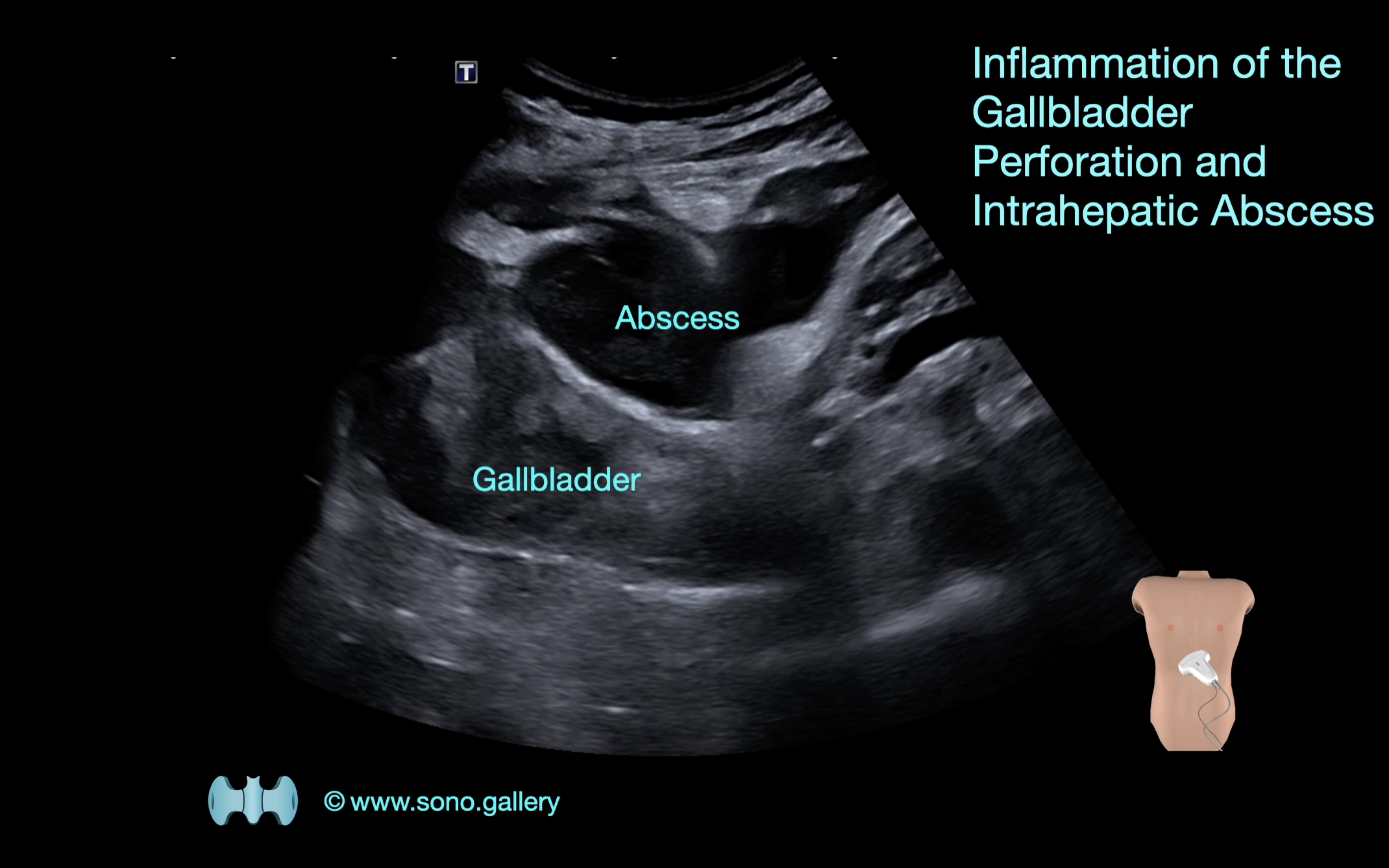 Inflammation of the Gallbladder (Cholecystitis), Intrahepatic Abscess