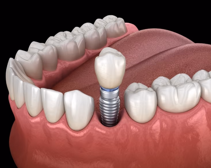 The 5 Most Frequently Asked Questions About Dental Implants