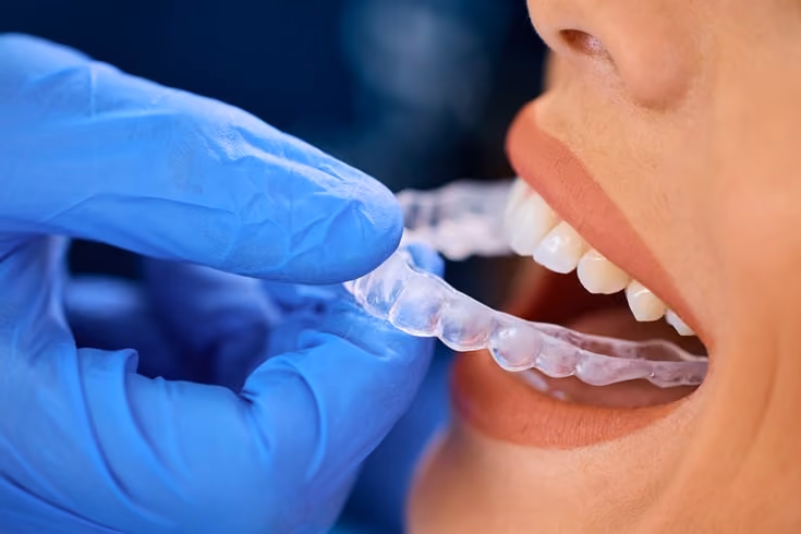 Do You Need a Retainer After Clear Aligners?