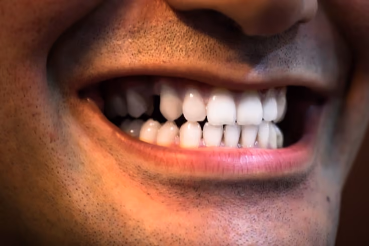 How Teeth Whitening Can Boost Your Confidence?