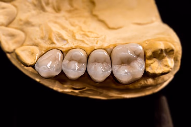 When Your Dental Crowns Break: A Comprehensive Guide