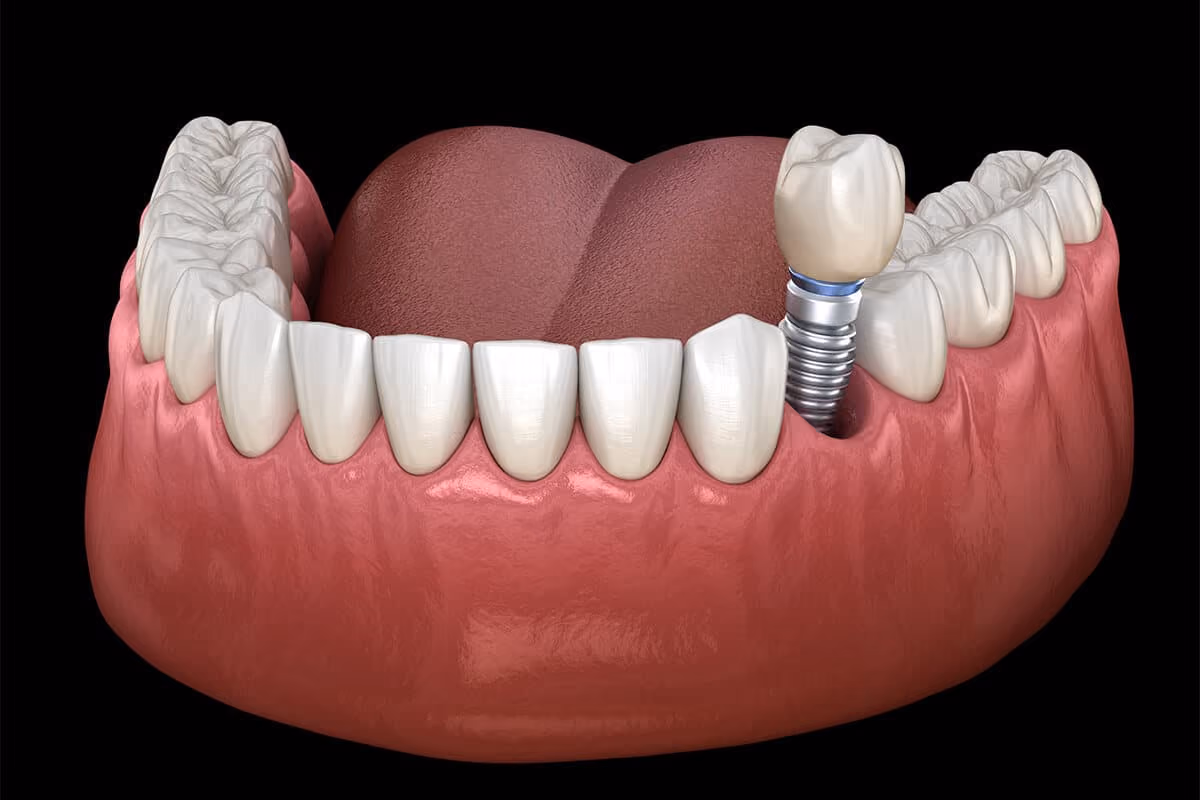The Effect of Smoking on Dental Implants