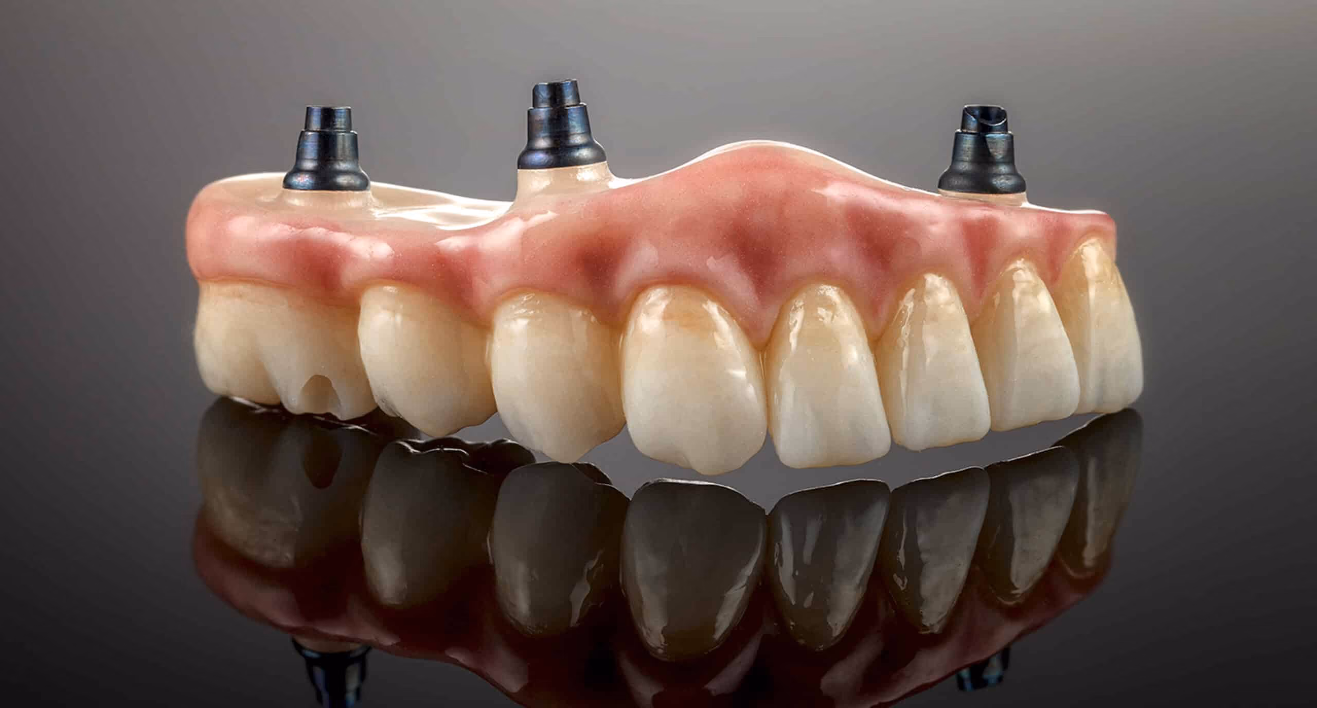 Implant-supported dentures for patients with bone loss