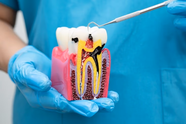 What to Expect After a Root Canal: Recovery and Aftercare Tips