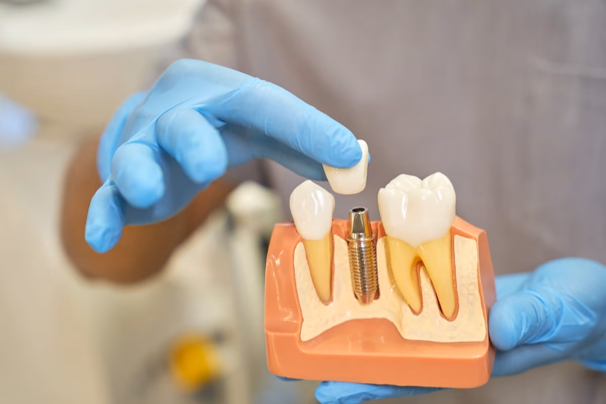 Dental Implants Lifespan in Houston, TX