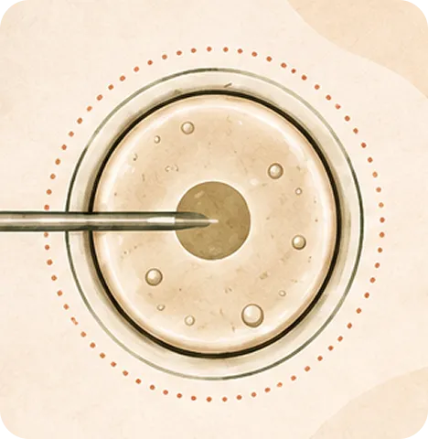 Illustration of ICSI: a fine needle injecting a single sperm directly into an egg.