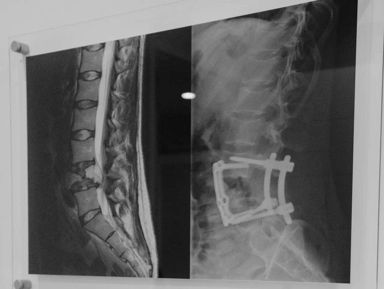 Lumbar spine