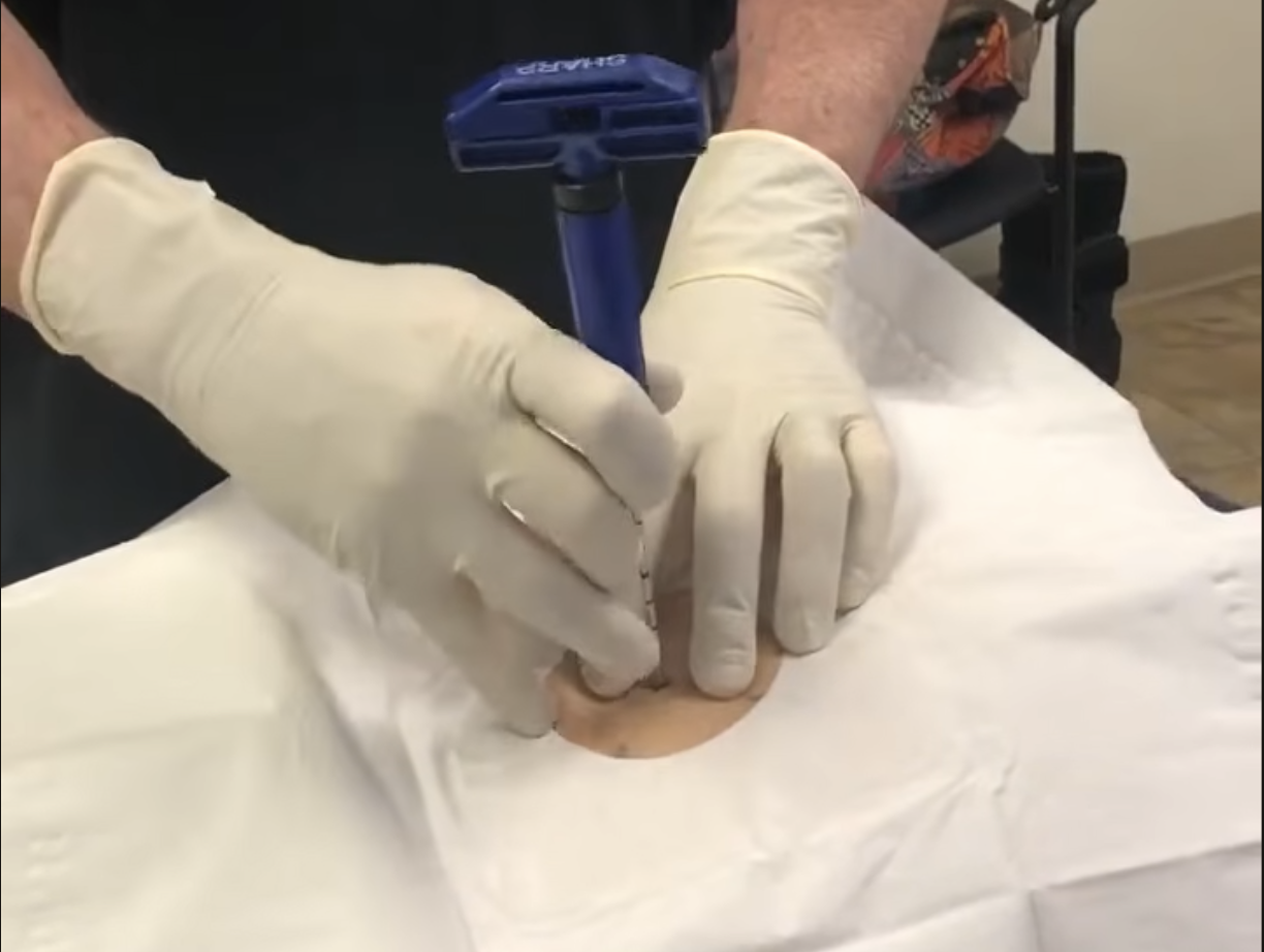 Introducing BMA Stem Cells: Using Your Own Bone Marrow to Support Healing