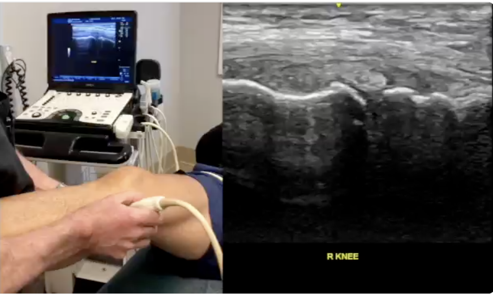 Split image of a physician performing ultrasound-guided knee injection alongside the live ultrasound image of the knee