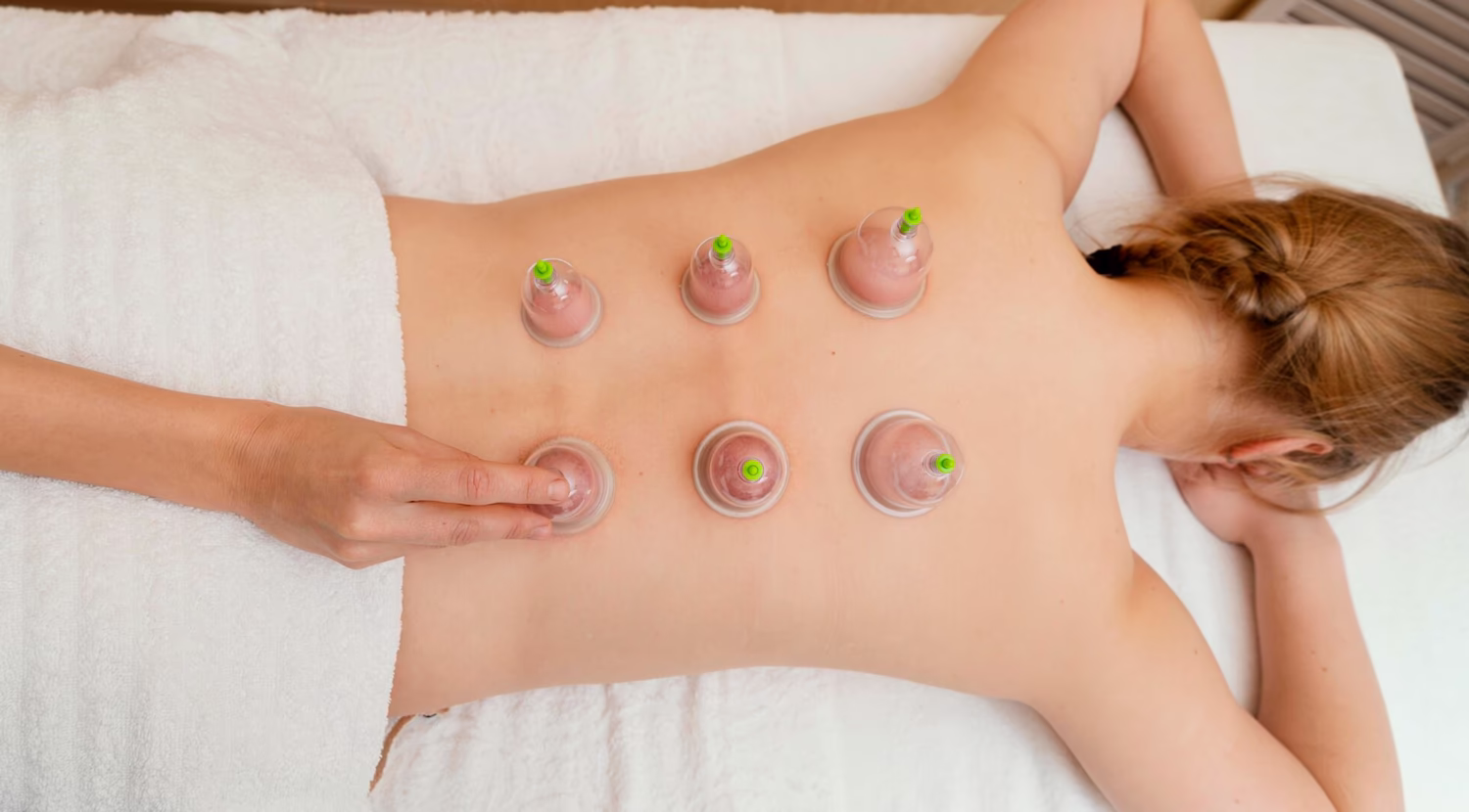 Cupping therapy cups on a woman's back