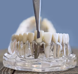 Dental implant model with tweezers placing an artificial tooth on a clear jaw model.