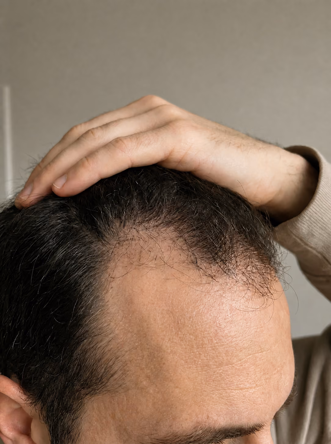 Ligne frontale qui recule chez un homme — premier signe de perte de cheveux