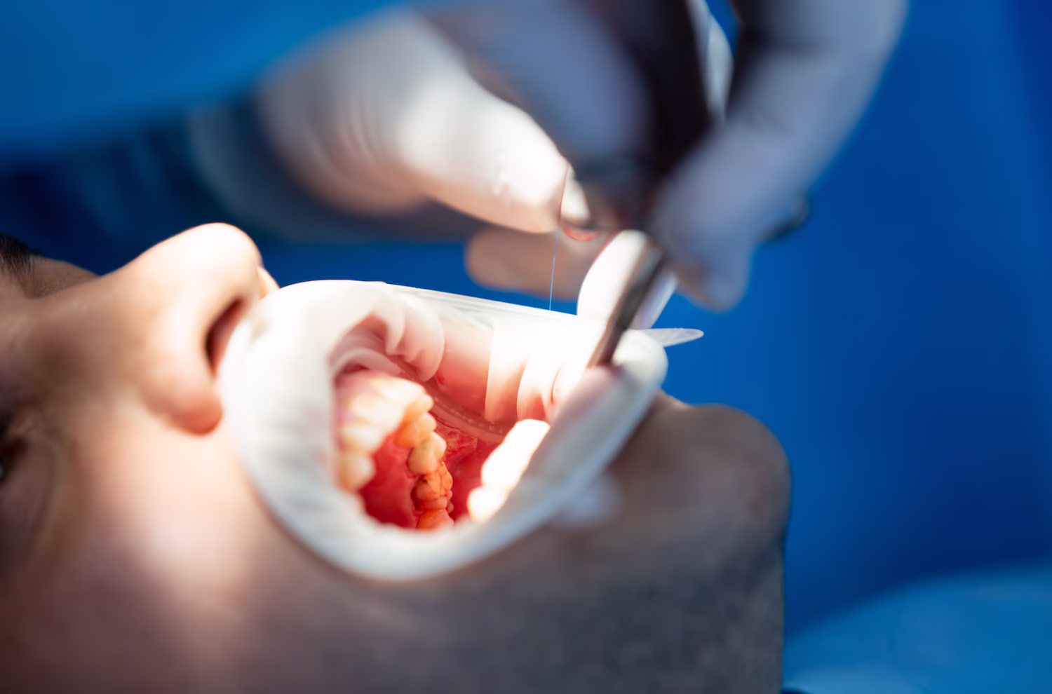 Periodontal (gum) surgery at Seaview Dental in Eatontown, NJ