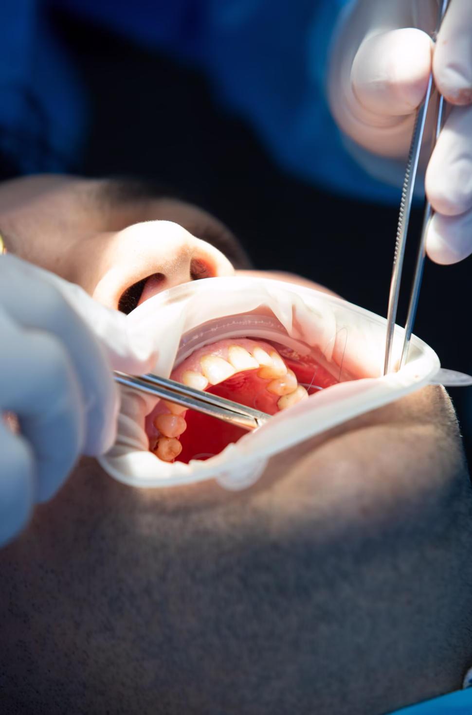 Close-up of a surgical dental procedure