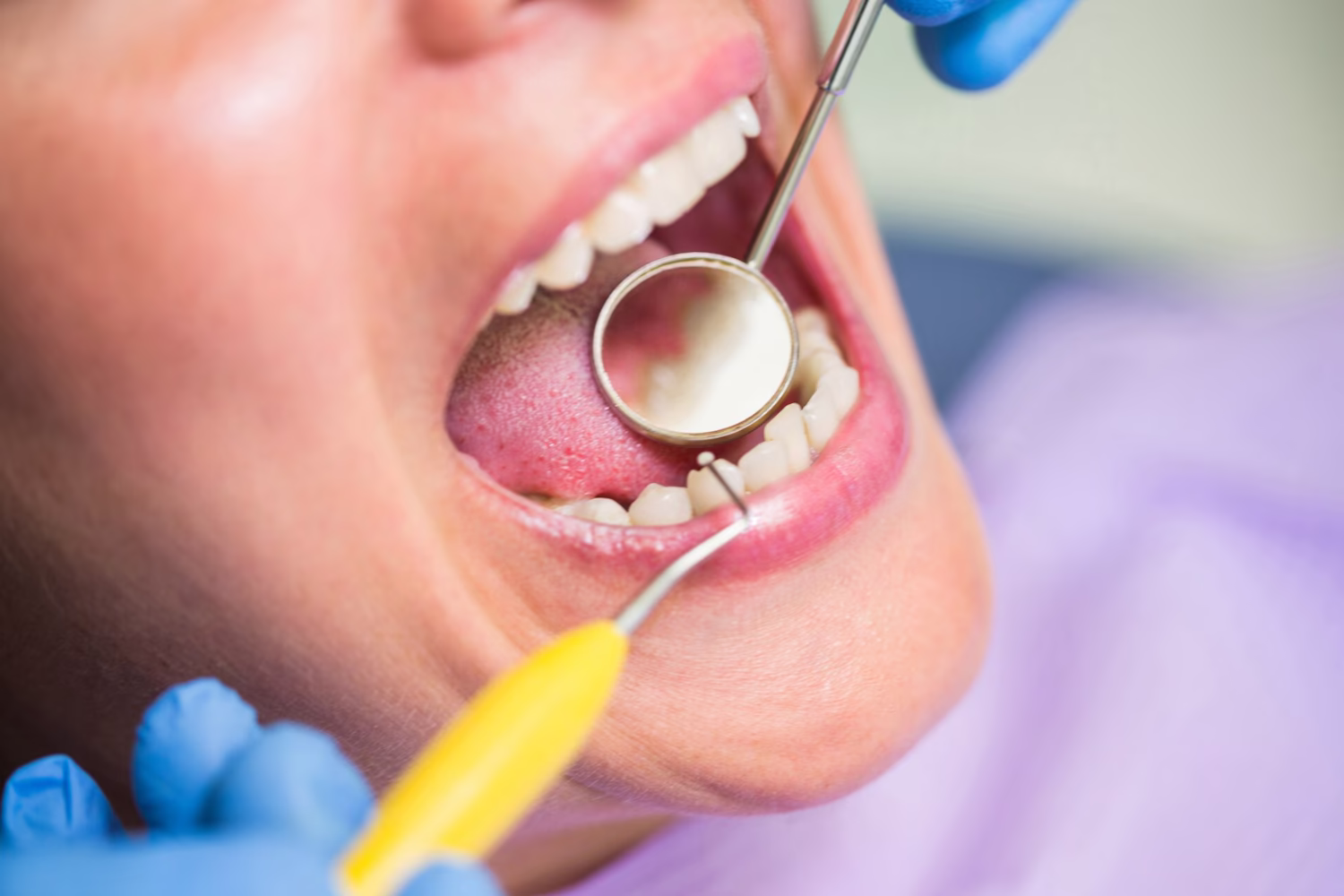 Dental mirror examining a patient's back teeth