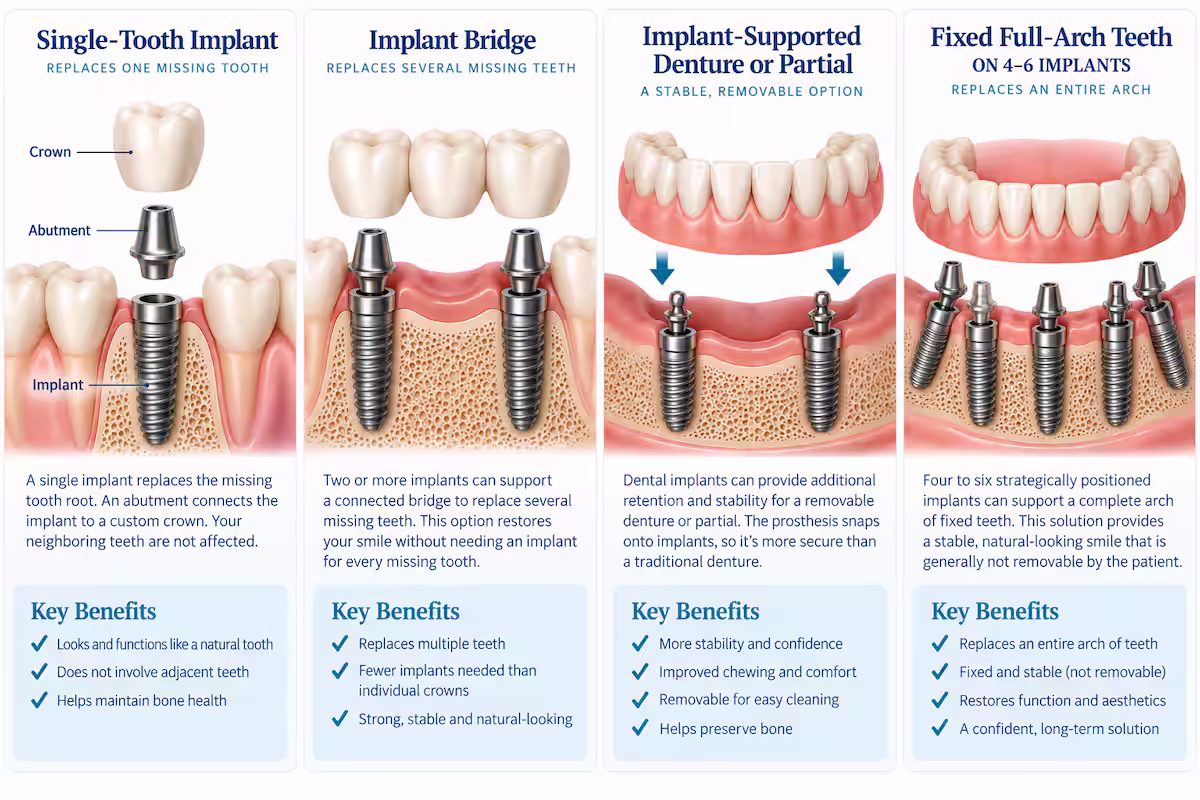 Comparison of four dental implant types: single-tooth implant, implant bridge, implant-supported denture, and fixed full-arch teeth.
