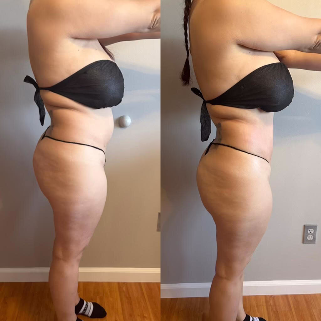 Before and after body contouring, side view