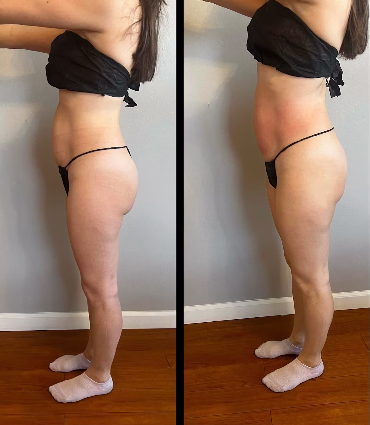Abdominal contouring