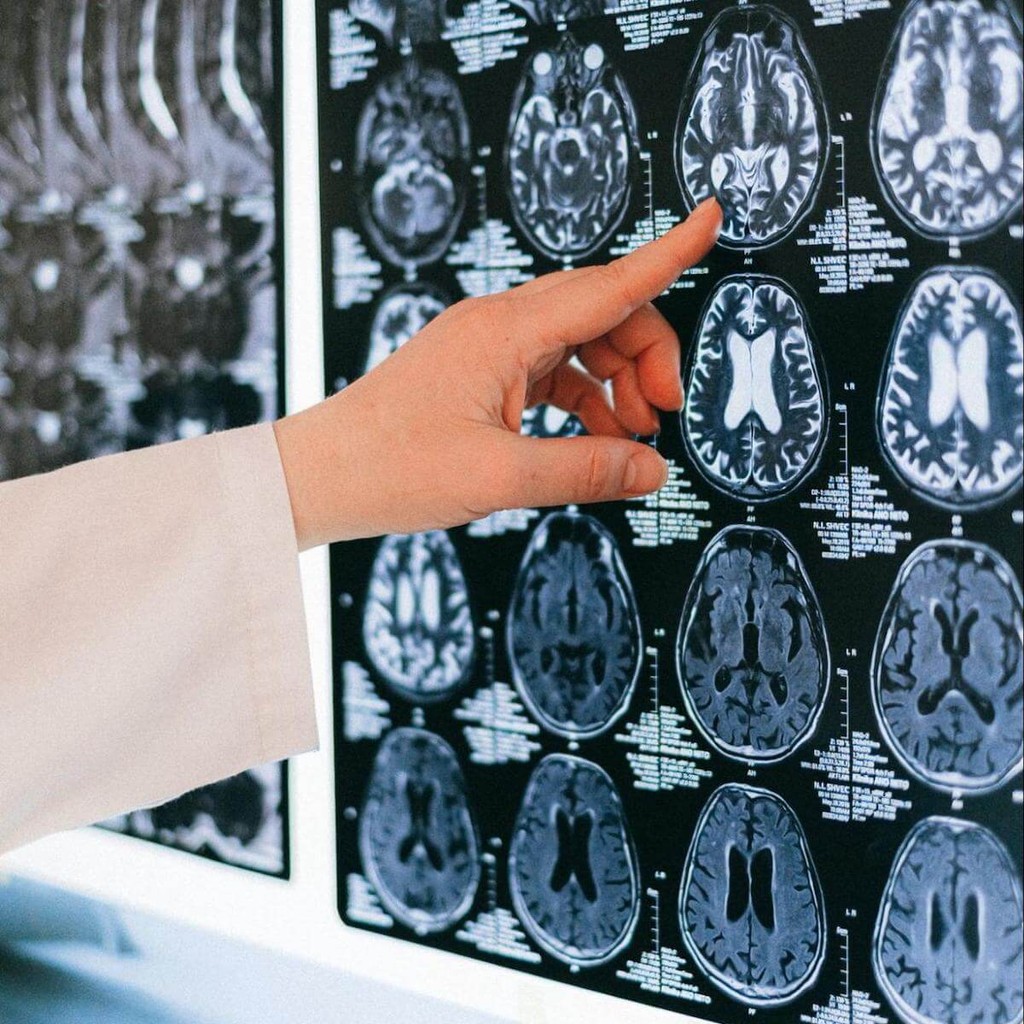 Doctor pointing at multiple brain MRI scans on a light box during medical examination