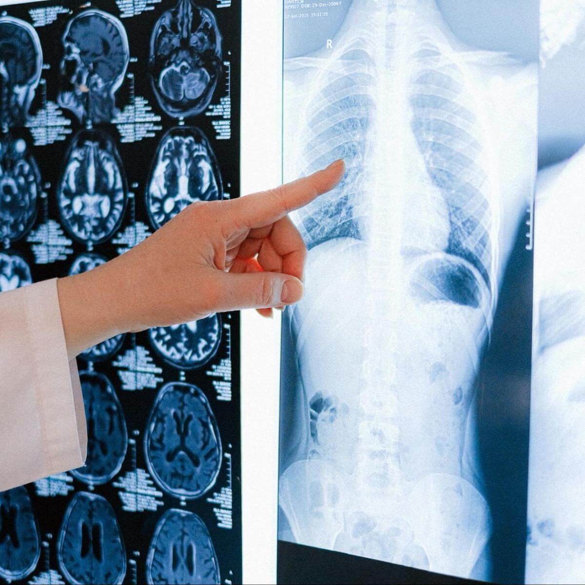 Doctor pointing to chest X-ray with brain MRI scans displayed on light box during medical imaging review