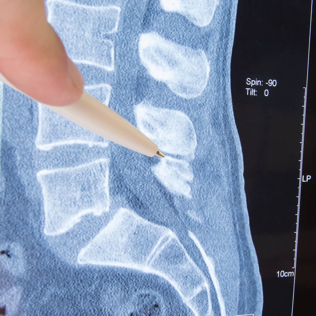 Clinician pointing to vertebra on spinal CT scan showing multiple vertebrae with imaging parameters displayed