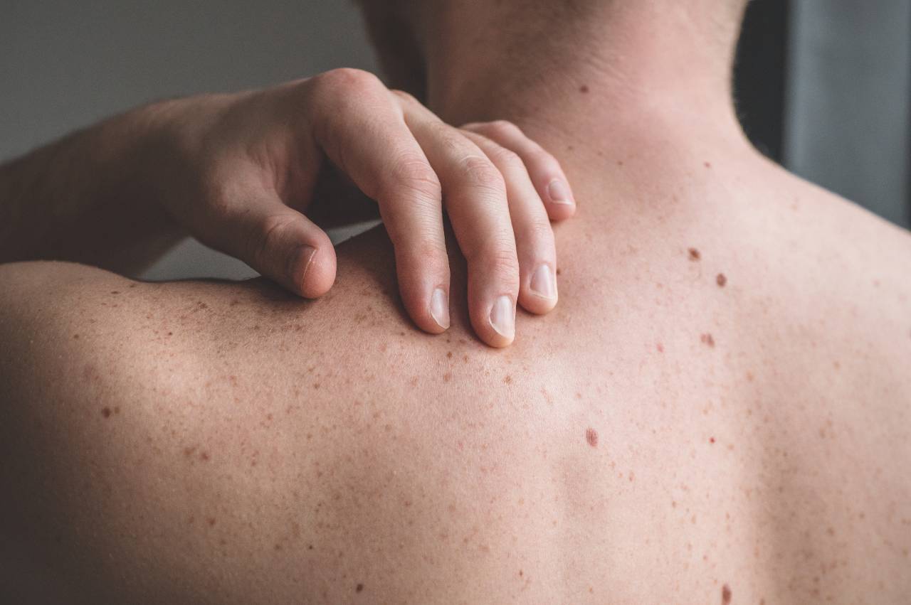Hand touching shoulder showing freckles and skin spots for skin health examination